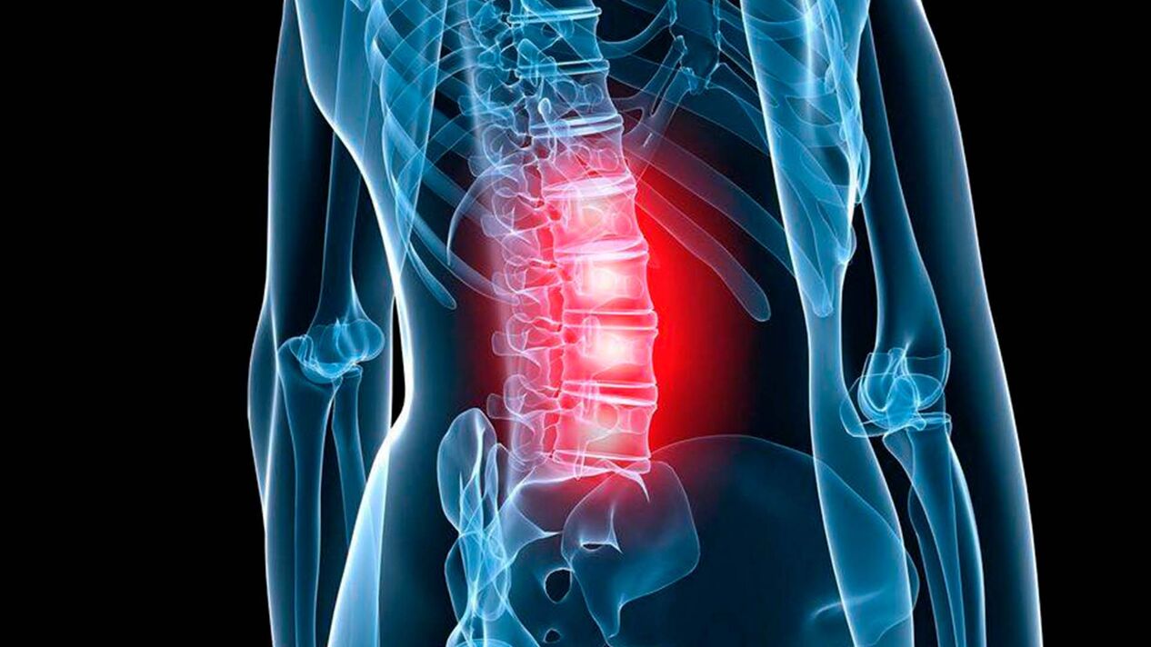príznaky bedrovej osteochondrózy