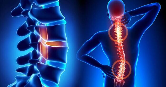 lokalizácia bolesti pri osteochondróze